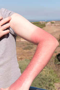Queimadura de sol no braço